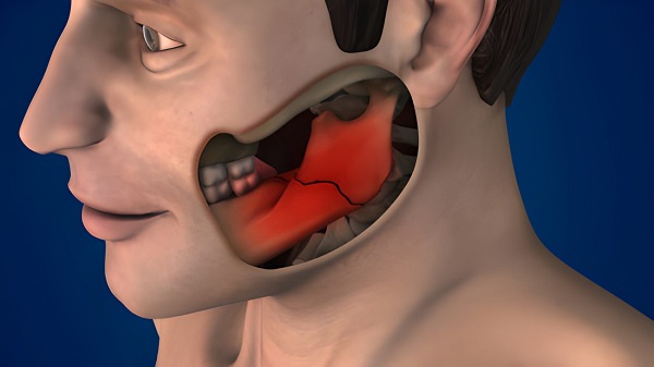 Best Facial fracture and Jaw Surgeon in Kharghar